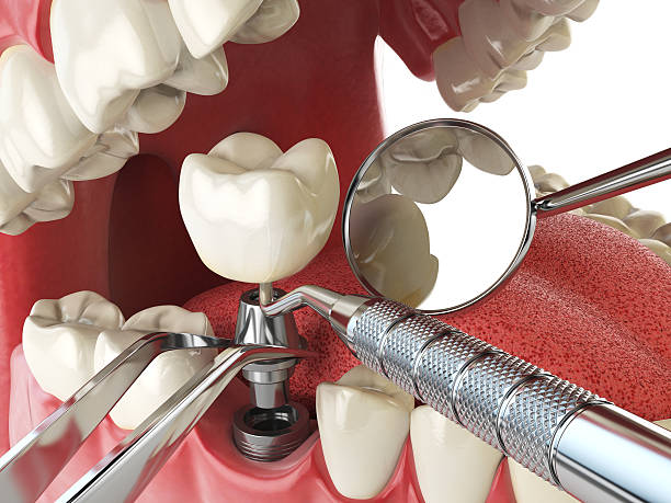 Best Emergency Dentist for Knocked-Out Tooth in Fisher, IL